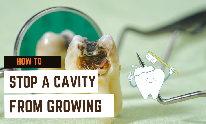 How To Stop a Cavity From Growing